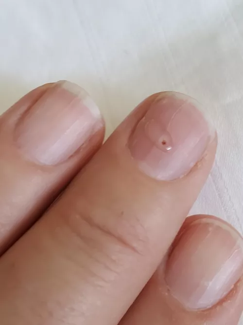 Regularly oozing plasma as my smashed my finger heals. I had to poke a hole in my nail to release the pressure and blood. by mntnsldr