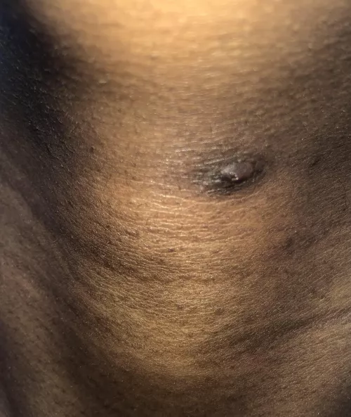 Removed ingrown hair now this. I try to pop it but it feels hard and when I squeeze it a little clear loquid comes out. It has a tiny hole in the middle. It’s been here for a year. I peeled the scarring off. I wanna squeeze it but it hurts. What can I  by KakashiHatakesWife
