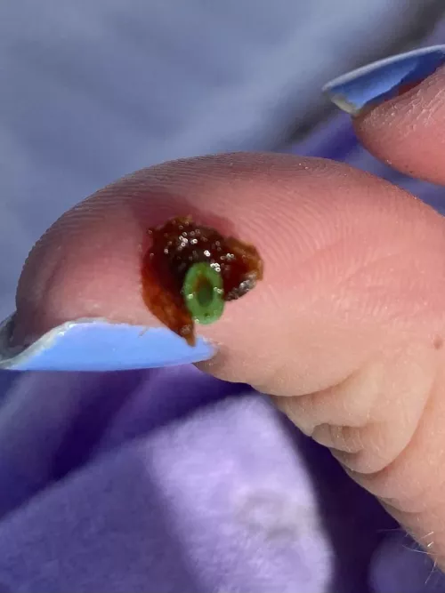 Saw something coming out of my daughter’s ear…her ear tube fell out along with a giant ball of earwax. by tort-alini