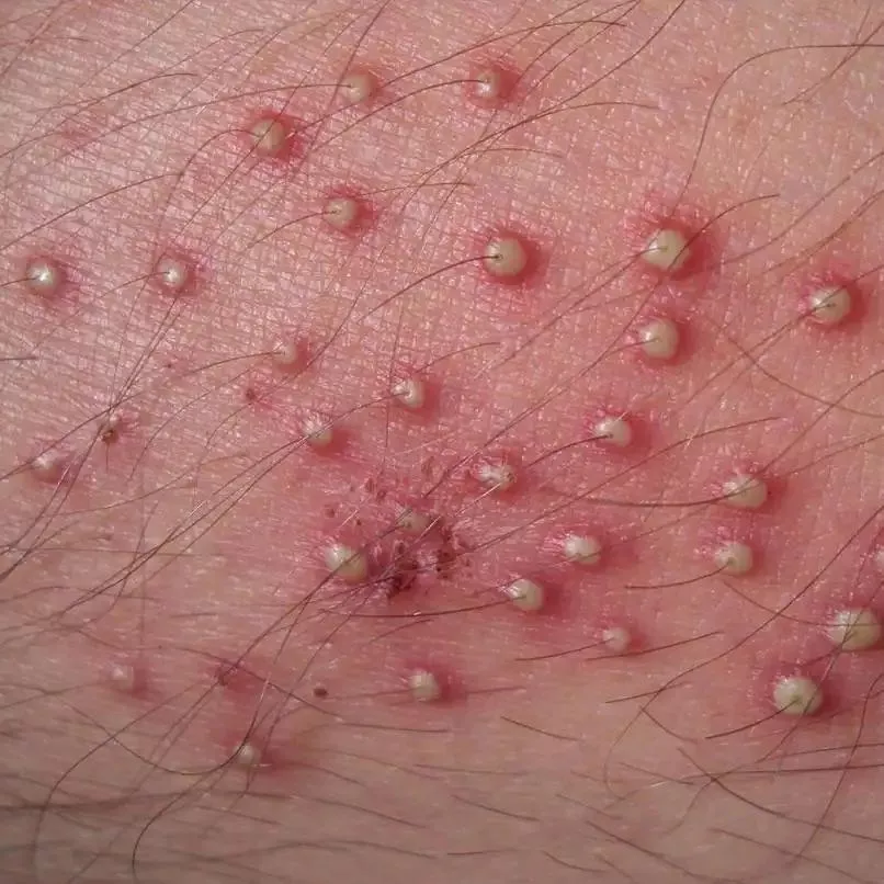 Saw this picture when googling pimple hairs. I would pay GOOD money to pluck those hairs out and pop the pus out after 🤤😭 posted by lickmewhereIshit