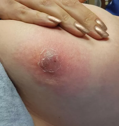 Say hello to my chest cyst. by sasqu_atch