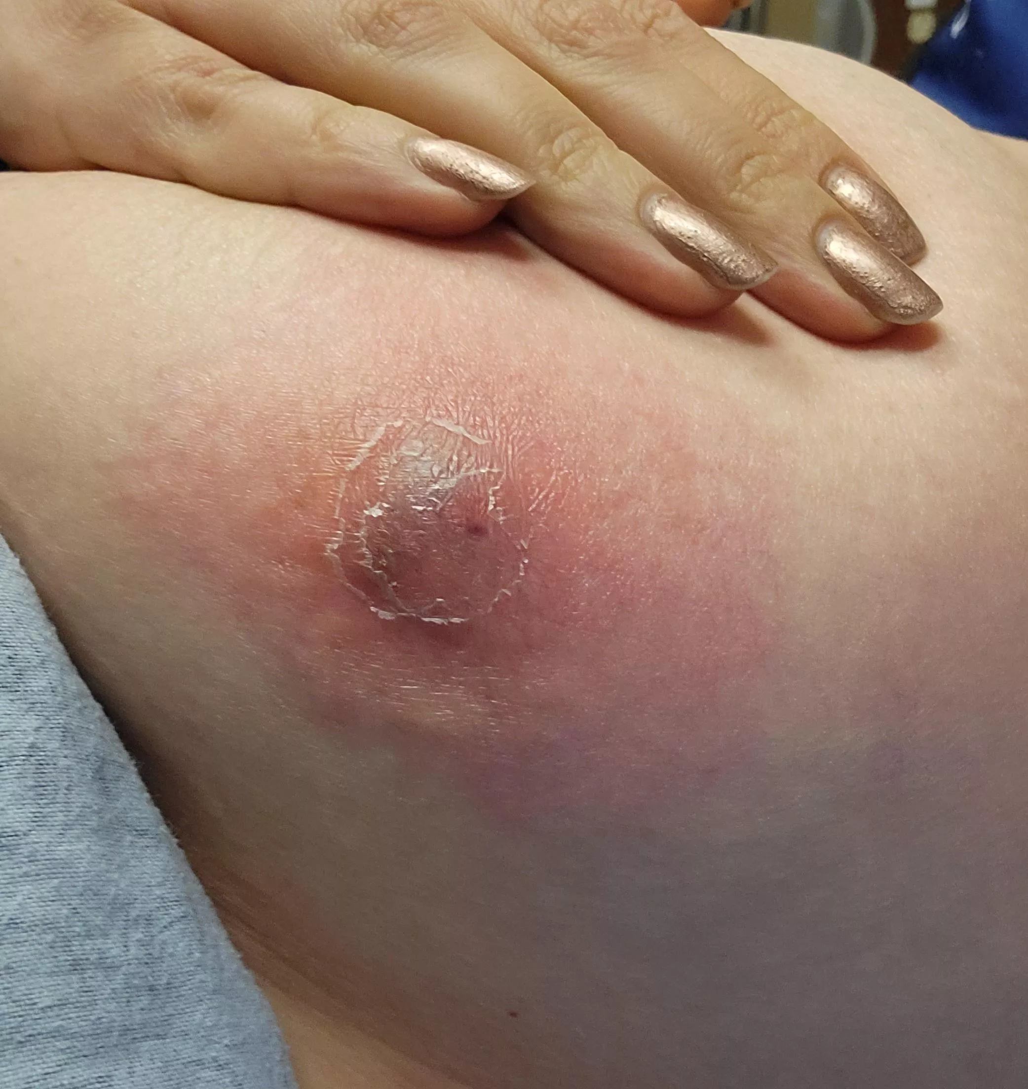 Say hello to my chest cyst. posted by sasqu_atch