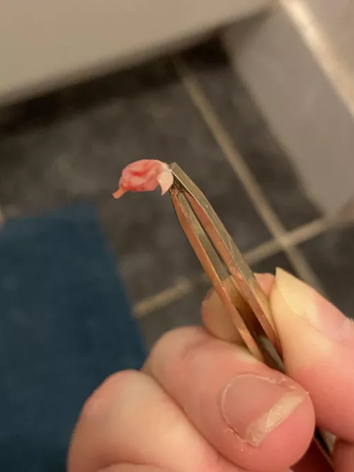 Sebaceous cyst sac came out voluntarily a week after it popped on its own. The doc was impressed! 😂 by kate468