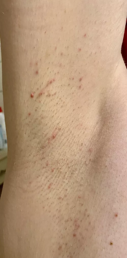 Shaving was a mistake 🤣 by sunnypits