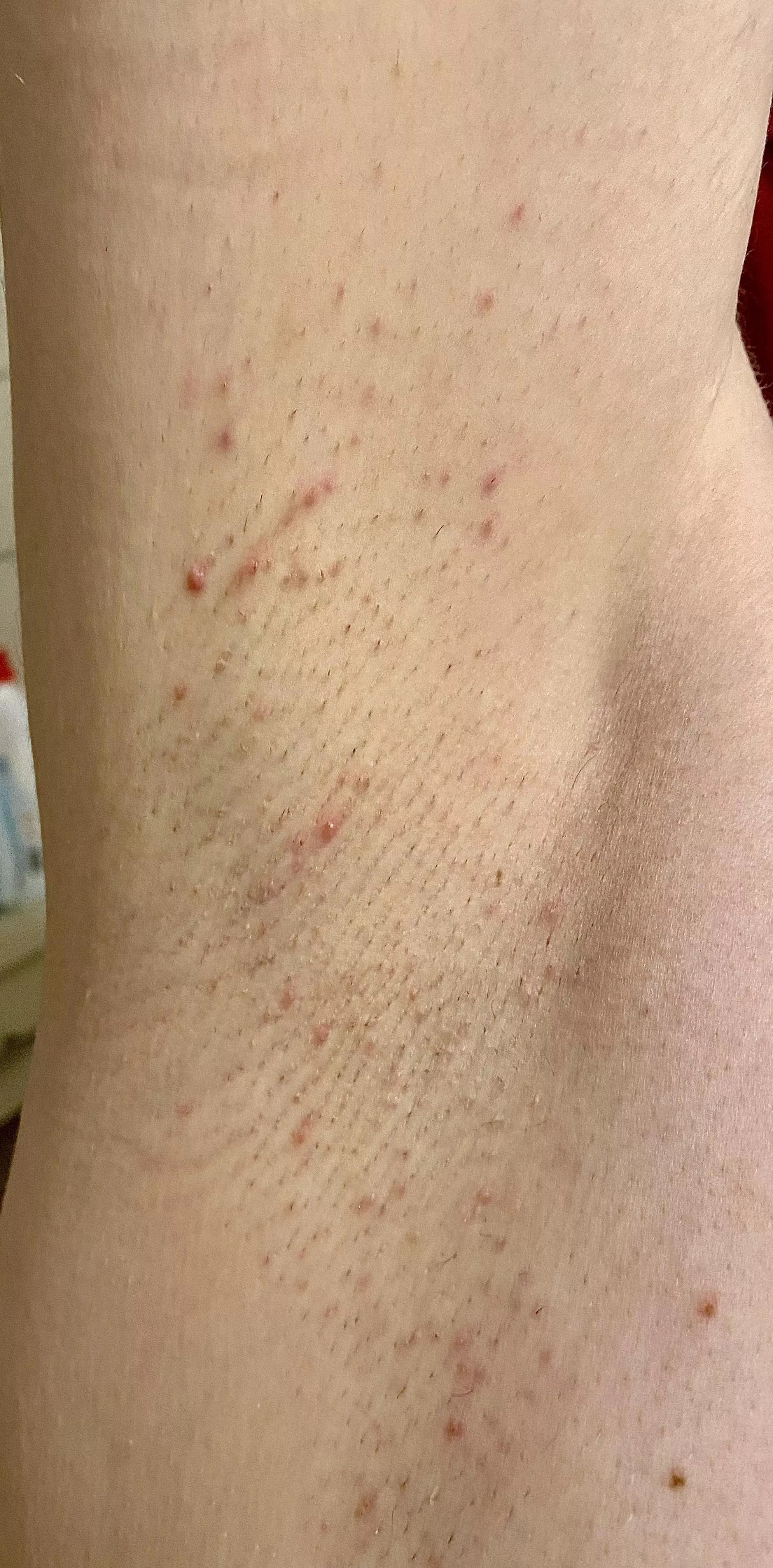 Shaving was a mistake 🤣 posted by sunnypits