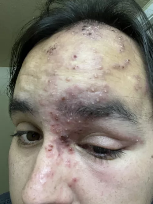 Shingles sure are fun! (Not) by OldDirtyBarrios