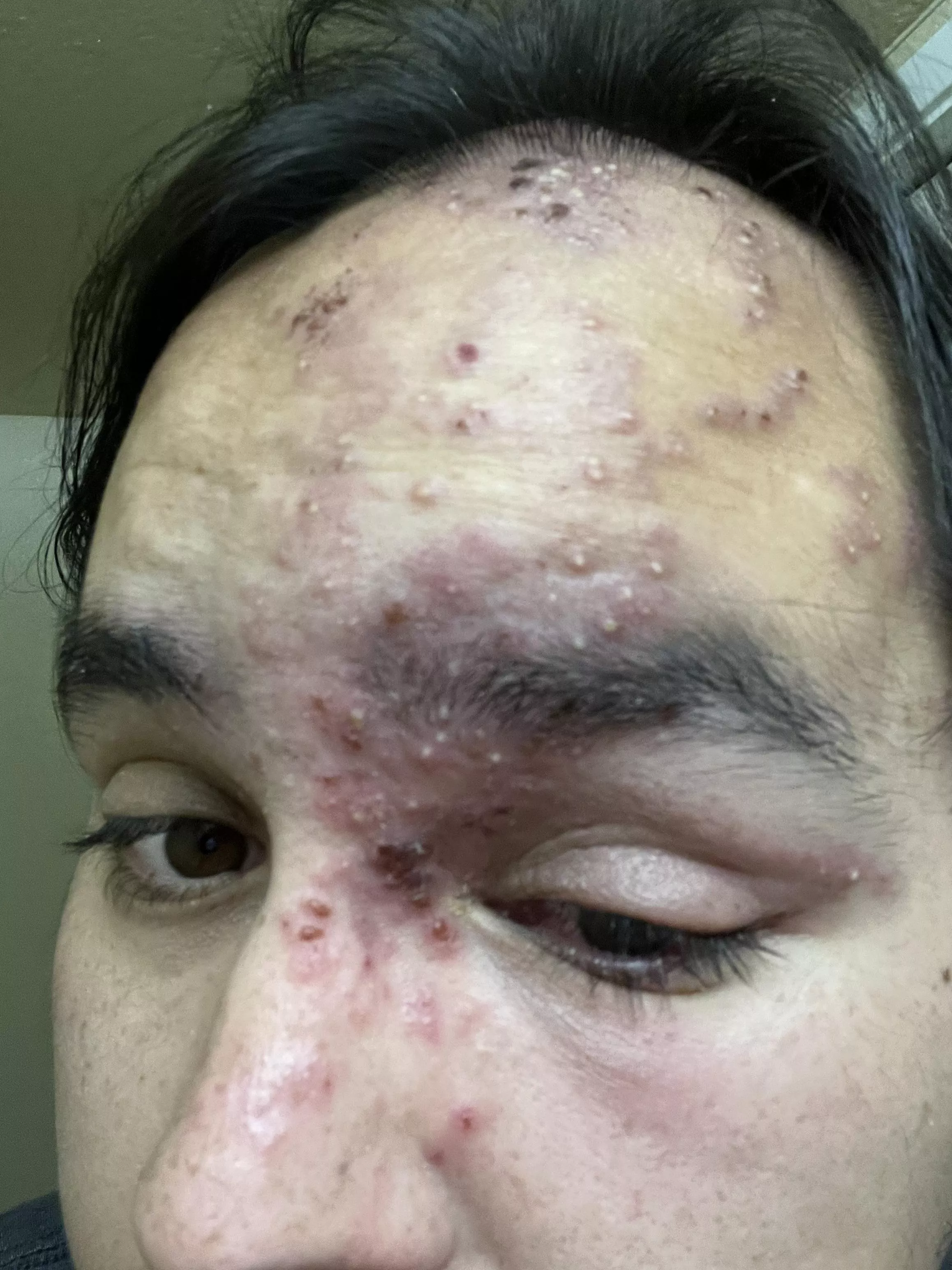 Shingles sure are fun! (Not) posted by OldDirtyBarrios