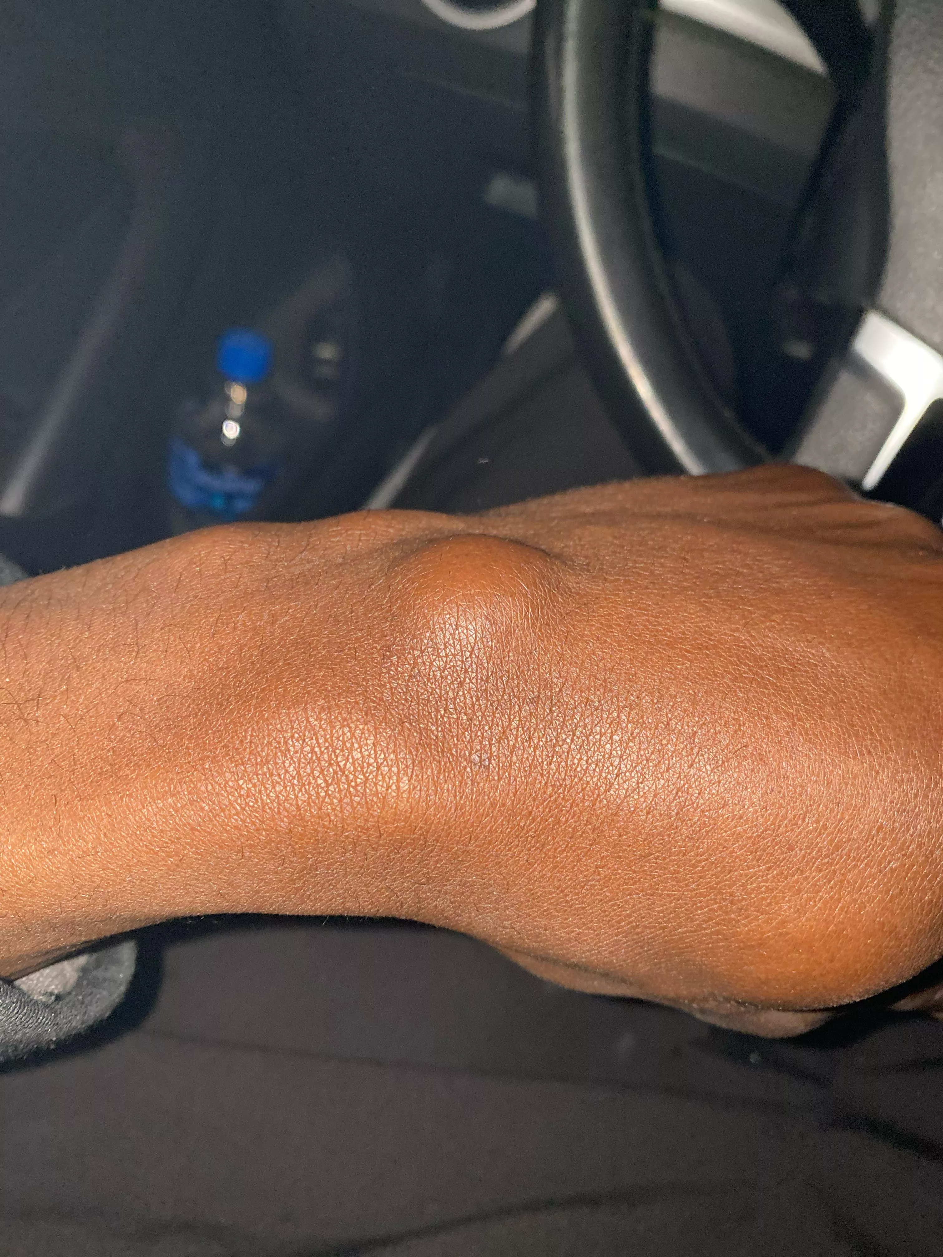 Should I pop it. I’ve had for about a year and half same size no pain posted by BILLC43