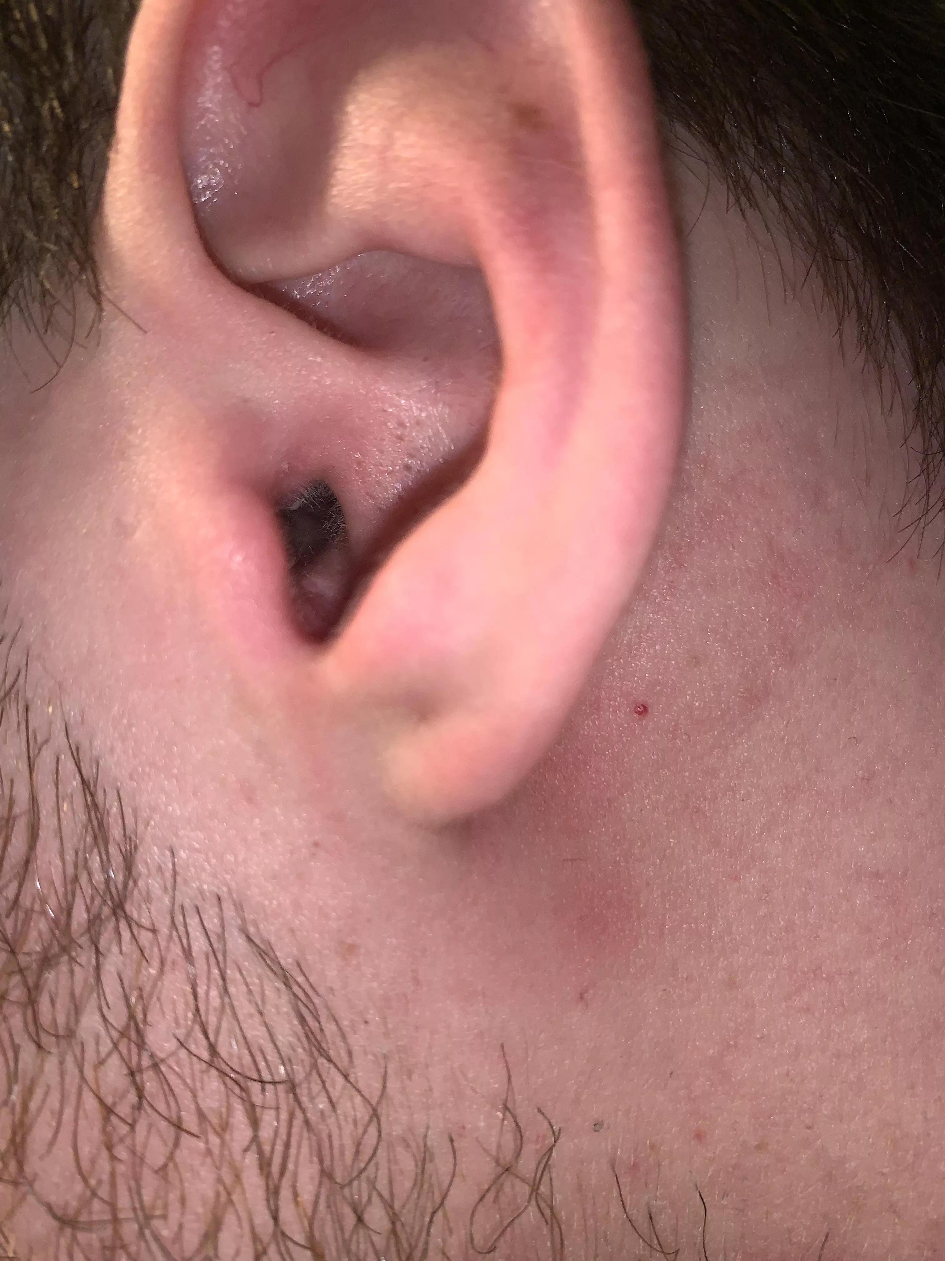 Should I pop that zoom in the ear canal there’s somthing white and my ear is in rediculous pain right now posted by Guybud99