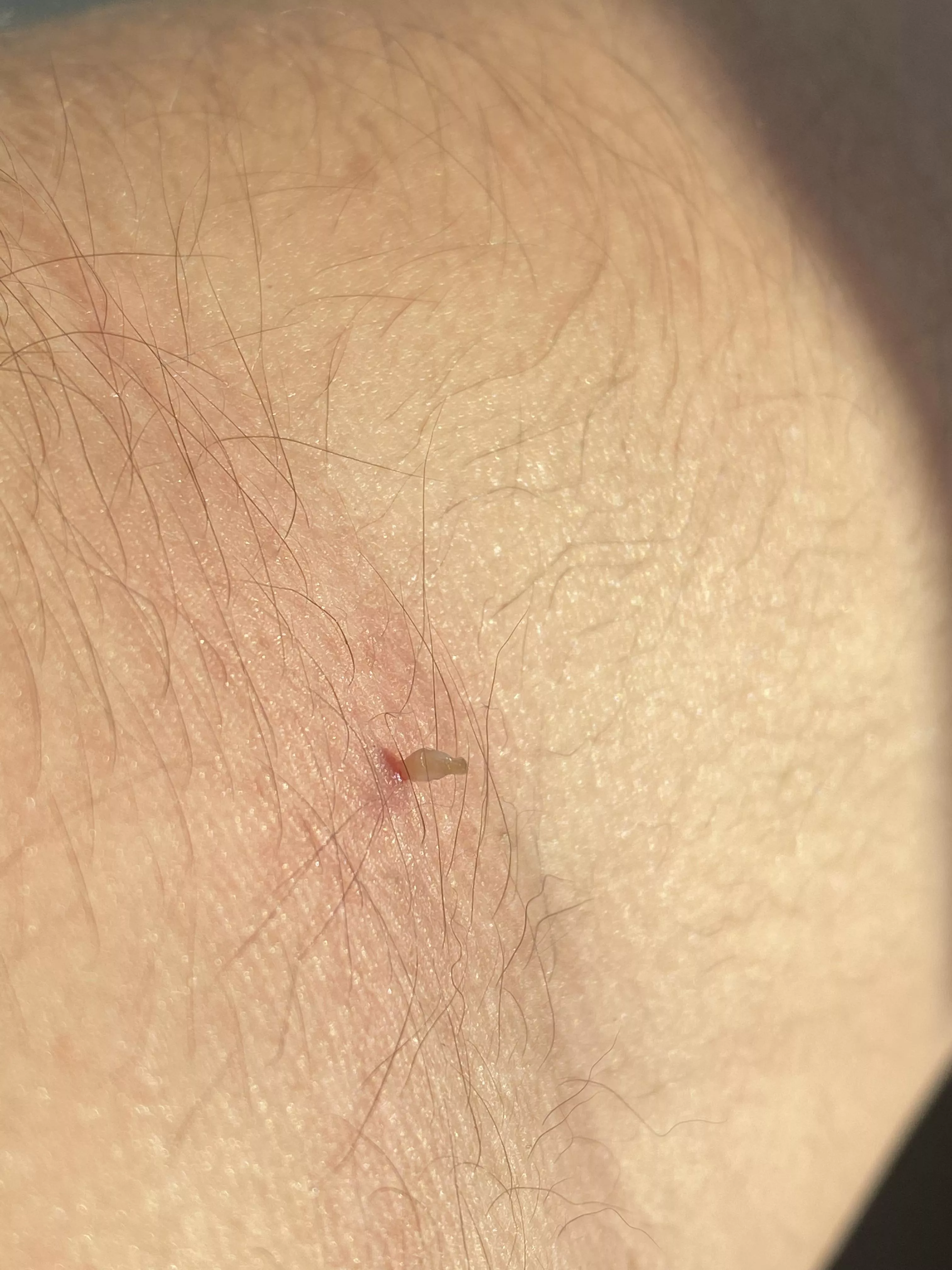 Small blackhead on arm :) I popped yesterday posted by Elias_Munoz00