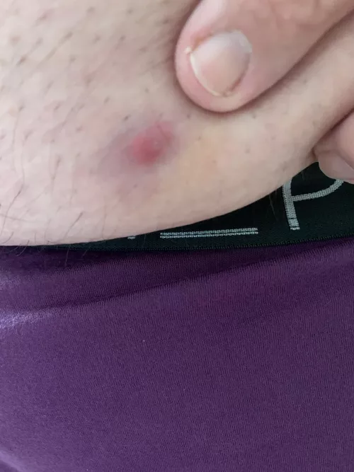 So it begins…ingrown or pus. by flub66