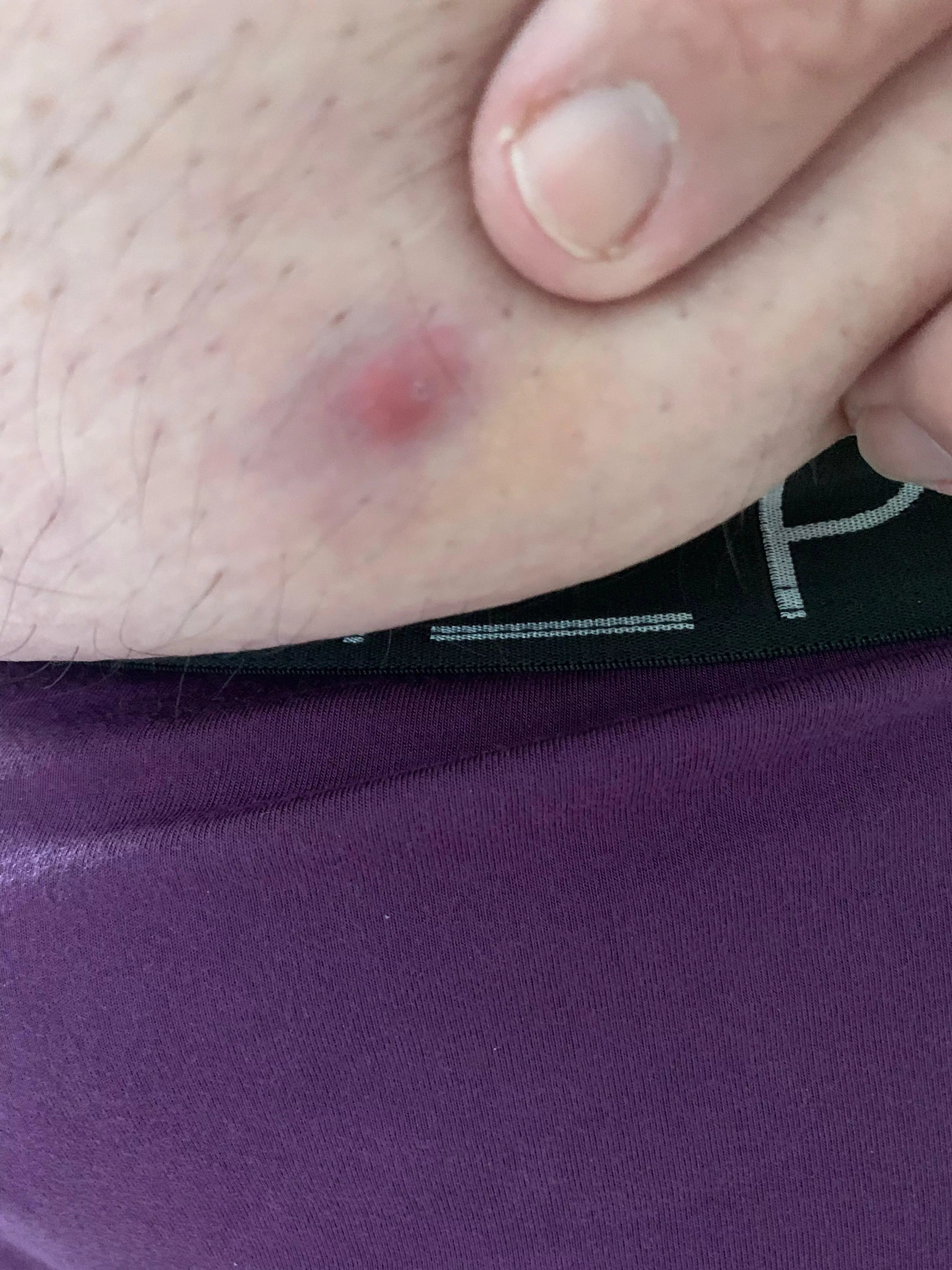 So it begins…ingrown or pus. posted by flub66