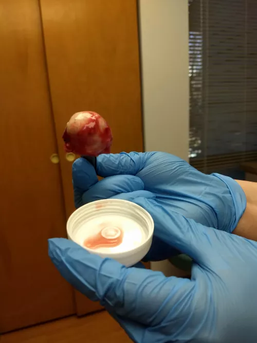 So last week I got this eyeball sized bastard removed by DogWHOspeaks