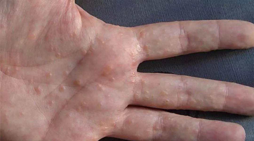 Some Dyshidrotic Eczema I had on my hands last year (both hands were covered like that, took over a month to clear up) posted by JackpotDeluxe