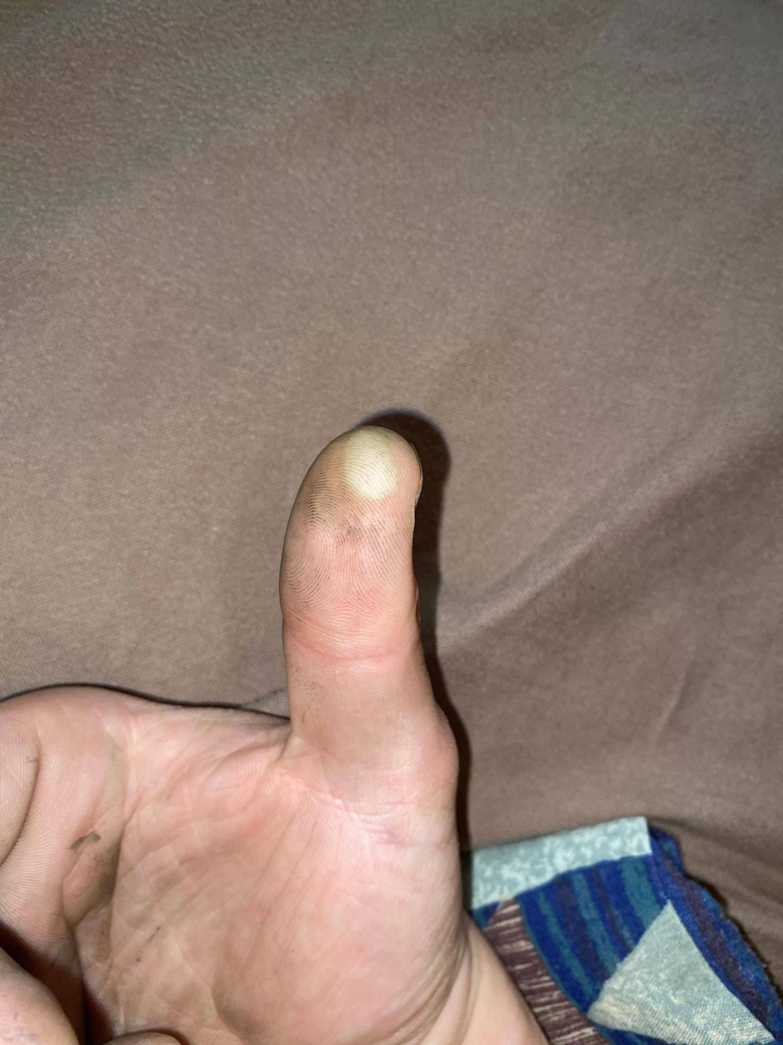 sorry about the dirty hands, just came from work and this stuff is impossible to get off. But does this blister look infected? 3-4 weeks old from working on car. posted by weinereater5000