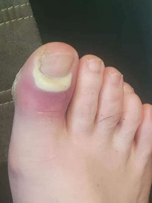 stepped out of the shower, discovered this when I was drying off. I'm diabetic, this is bad news. by DameLibrio