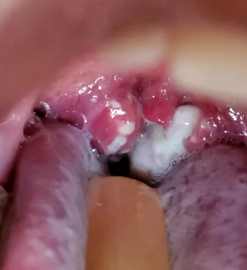 Strep Throat as an Adult: Day 5 of antibiotics by almosthere28