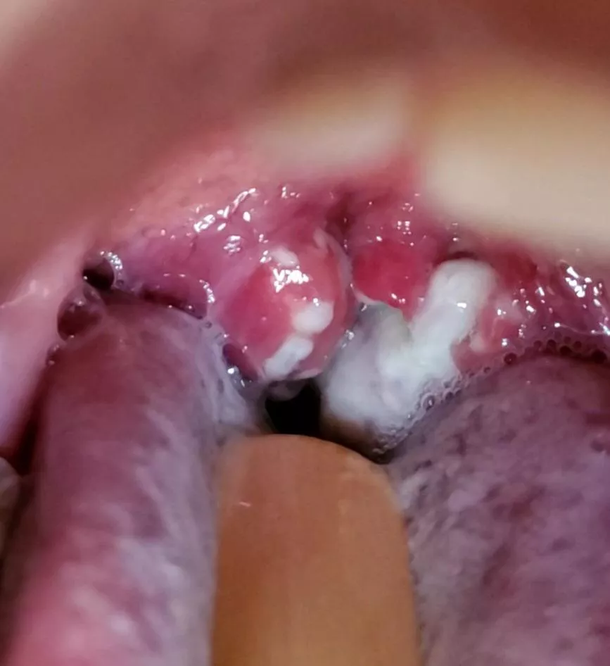 Strep Throat as an Adult: Day 5 of antibiotics posted by almosthere28