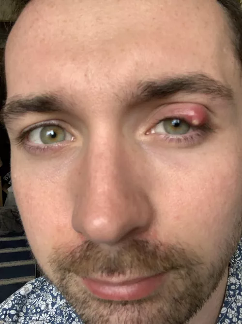 Stye that appeared a week ago. Finally came to a head, terrified to pop it, have an appointment tomorrow by throwaway7383942