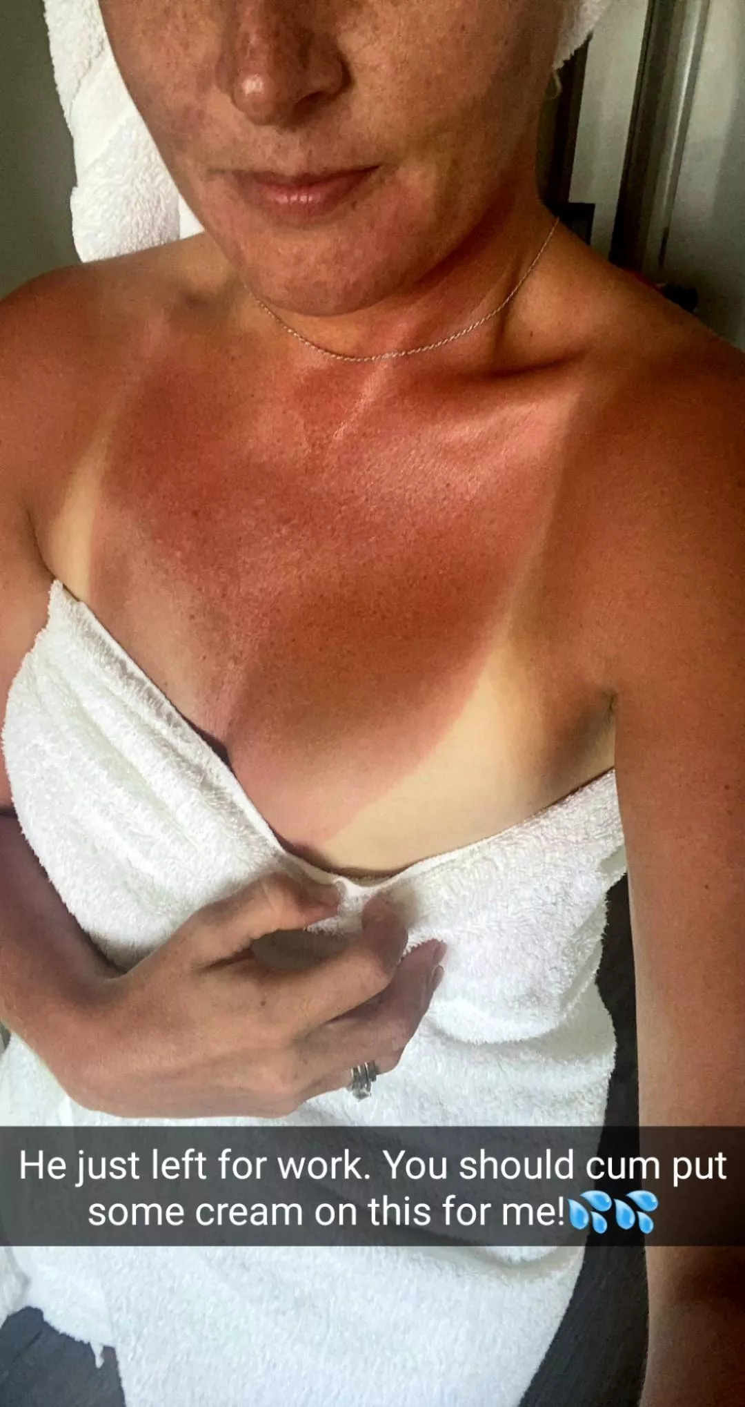 Sunburn posted by UpstateLady