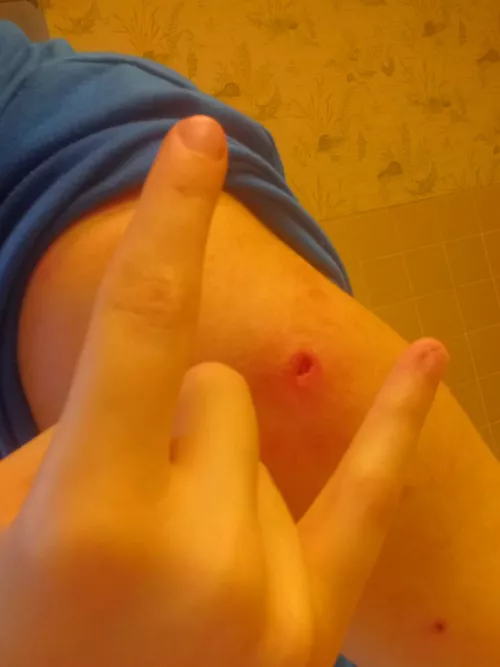 The big ass gnarly hole in my arm after popping a really bad pimple. It felt so much better after I got all the crap out by bluedoggxx