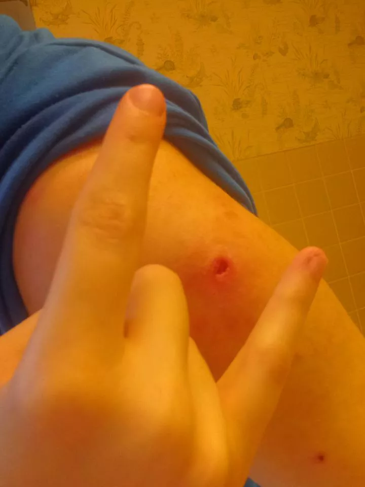The big ass gnarly hole in my arm after popping a really bad pimple. It felt so much better after I got all the crap out posted by bluedoggxx