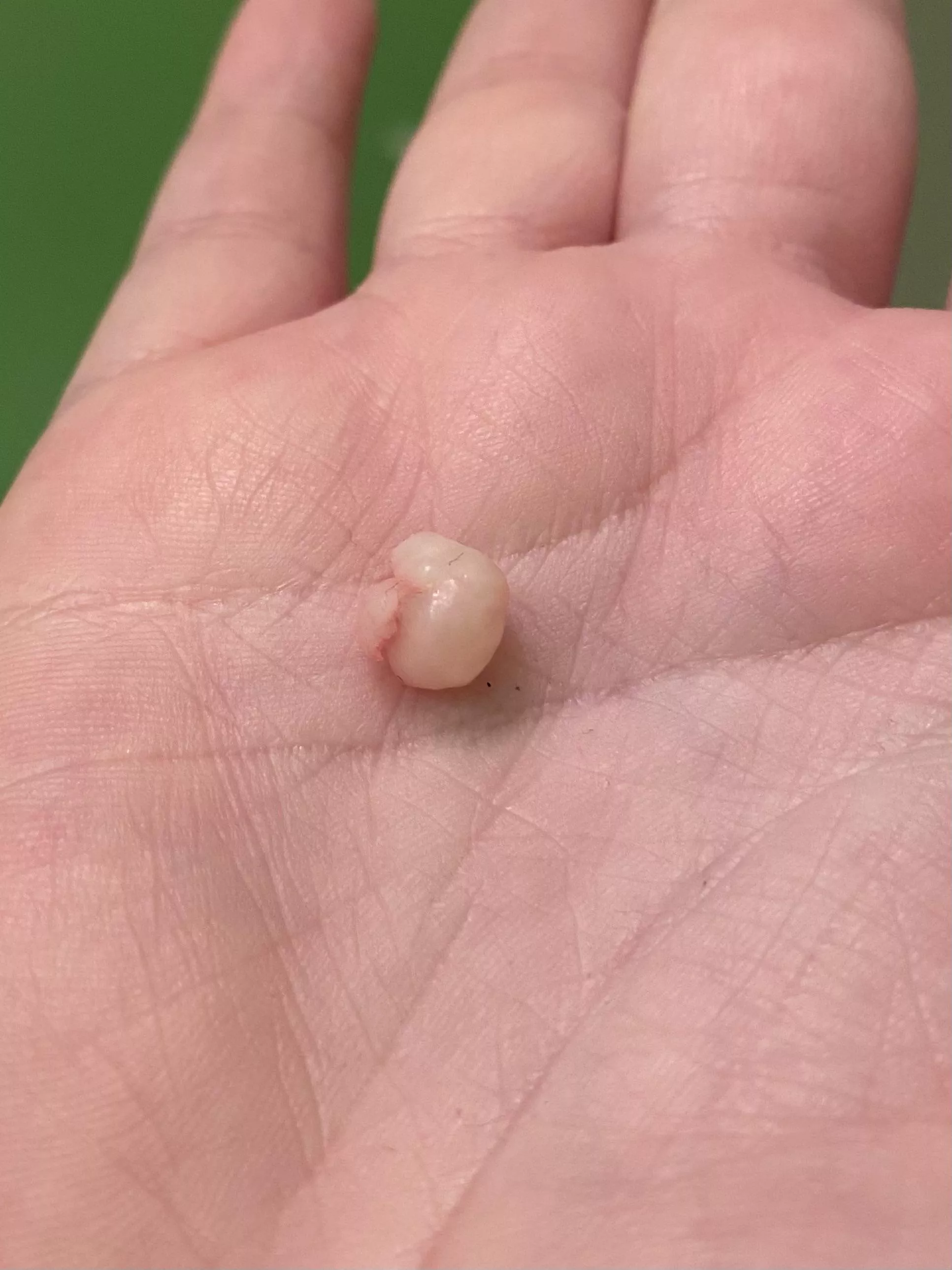 The latest cyst I excised today. This is the 2nd one. The first one had 3 in it. posted by PeteyPorkchops