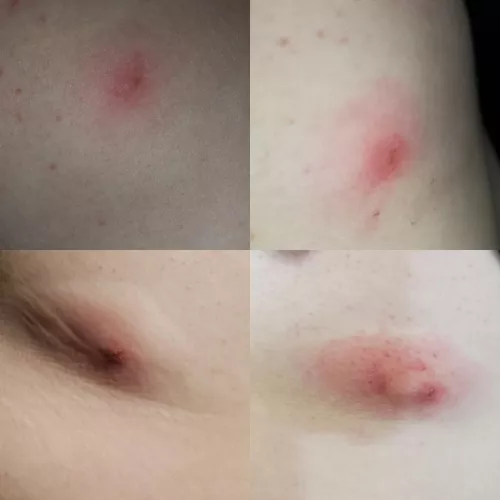 The progression of what I believe to be a spider bite on my side over just 24 hours. (yes I've seen a dr. ) by quietmania