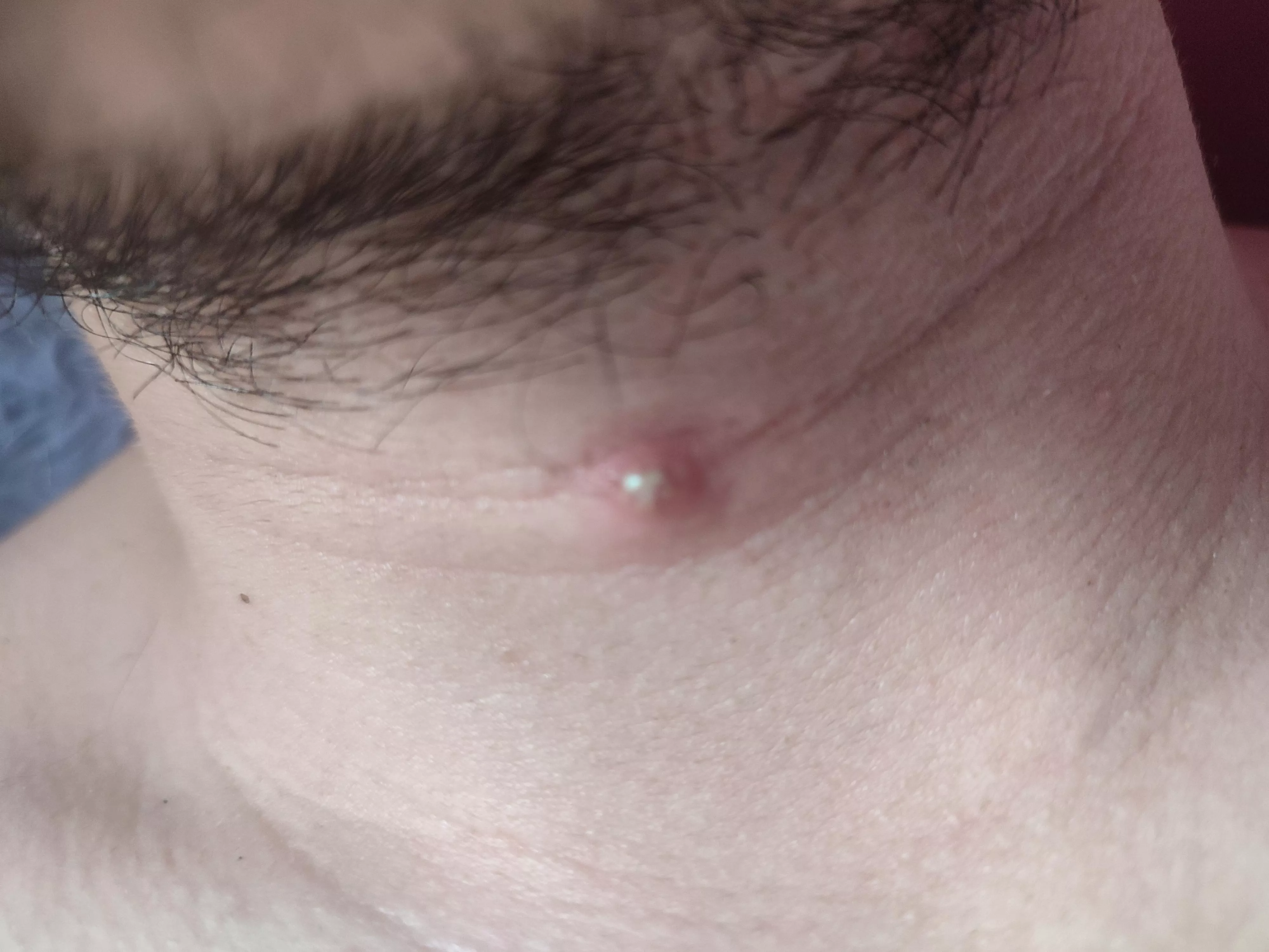 the pus blister on my boyfriends neck caused by shaving... he never lets me touch his spots and it's agonising to resist! it's gonna blow! 🤣 posted by Smart_Cookiex