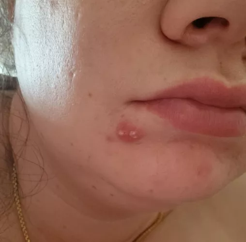 The temptation is strong with this double-headed spot... 4 days of patches and still no joy! by whiskey__throwaway