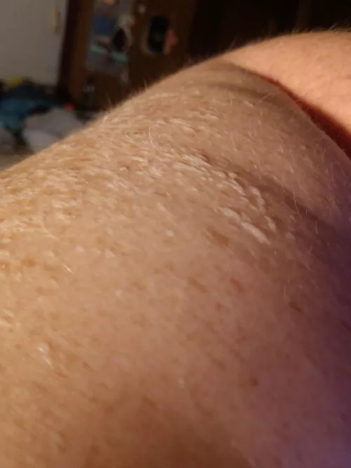 These are incredibly tiny, itchy, blisters. by ViaVitality01