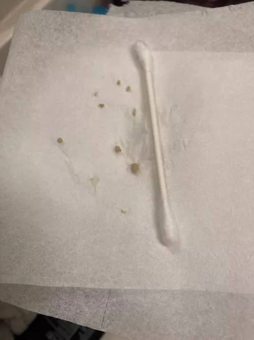 These guys popped out after I brushed my teeth… ugh q-tip for scale by Disastrous-Menu_yum