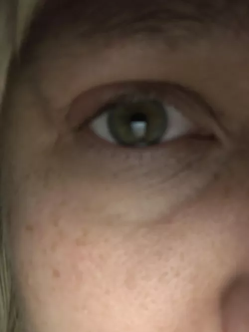 This baby is brewing hard. My eyelid hurts. If it pops you’ll be the first to know! by Uhhlaneuh