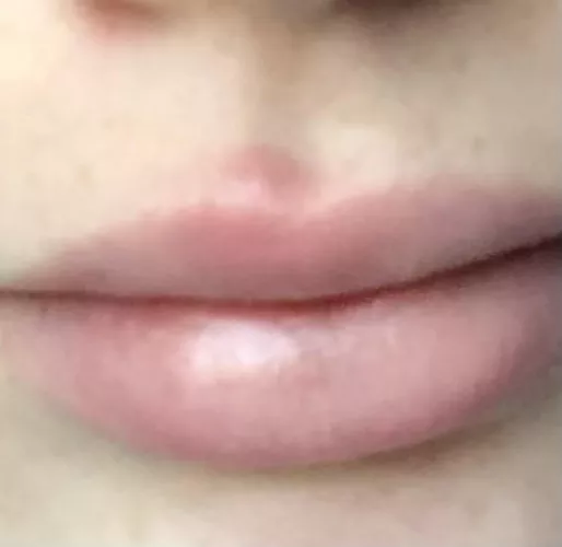 This big boys is hella painful and will not come to a head by Psychward_unit