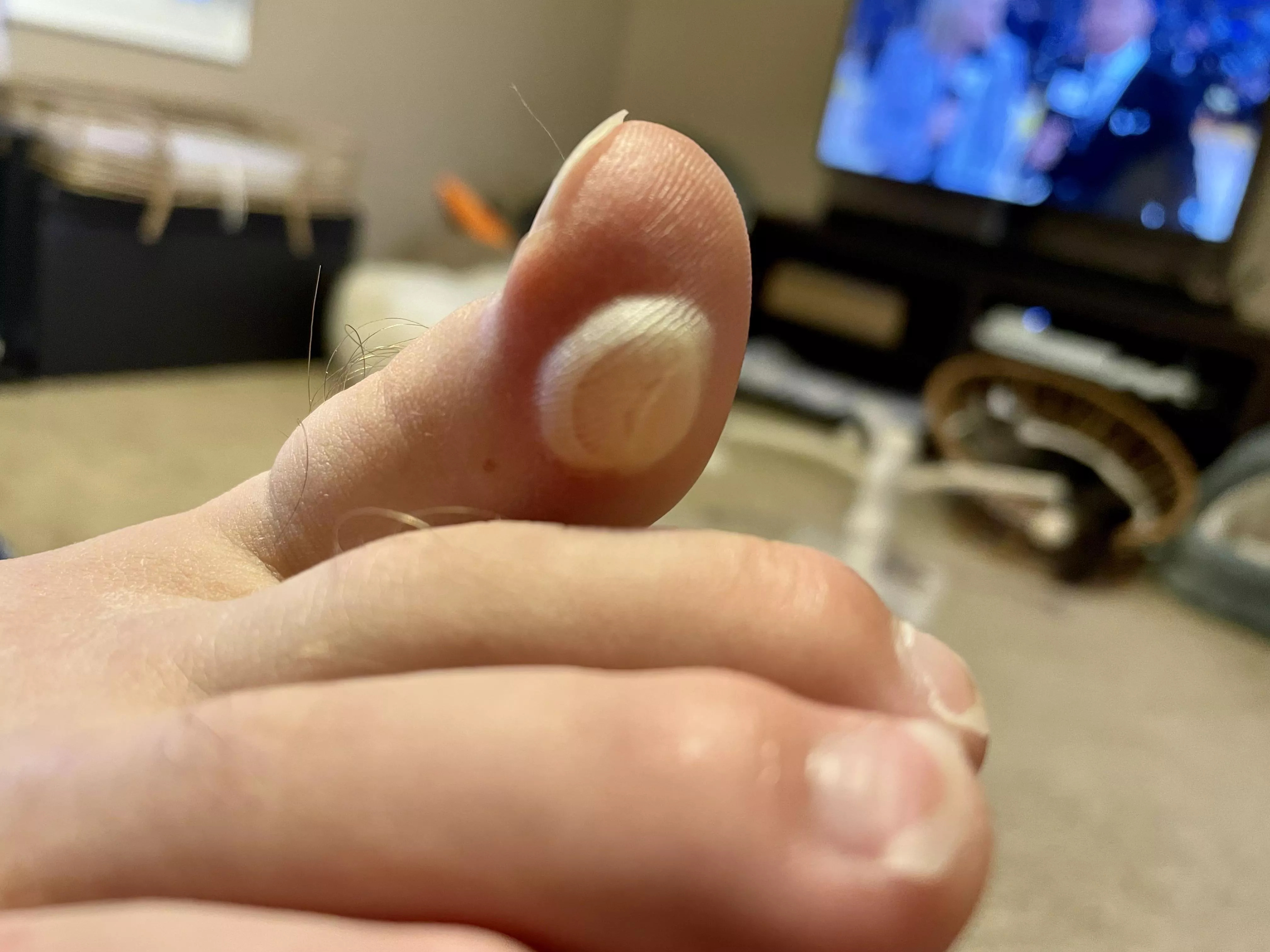 This forbidden one has been growing on my husbands big toe each time he plays basketball posted by catttastrophy