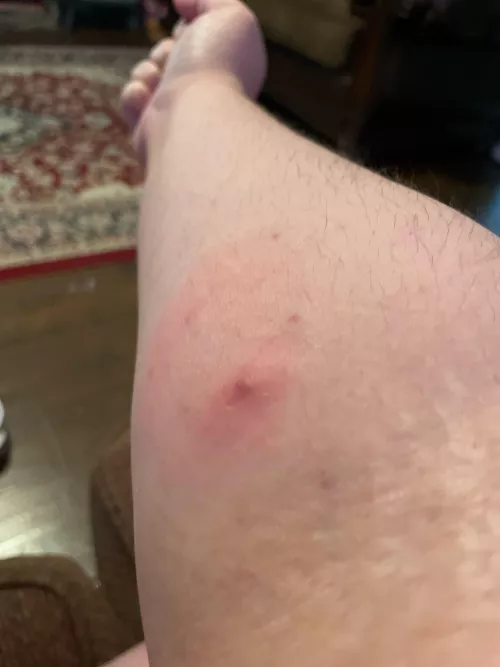 This forbidden pop showed up yesterday and it hurts when I curl my arm by Katybee18