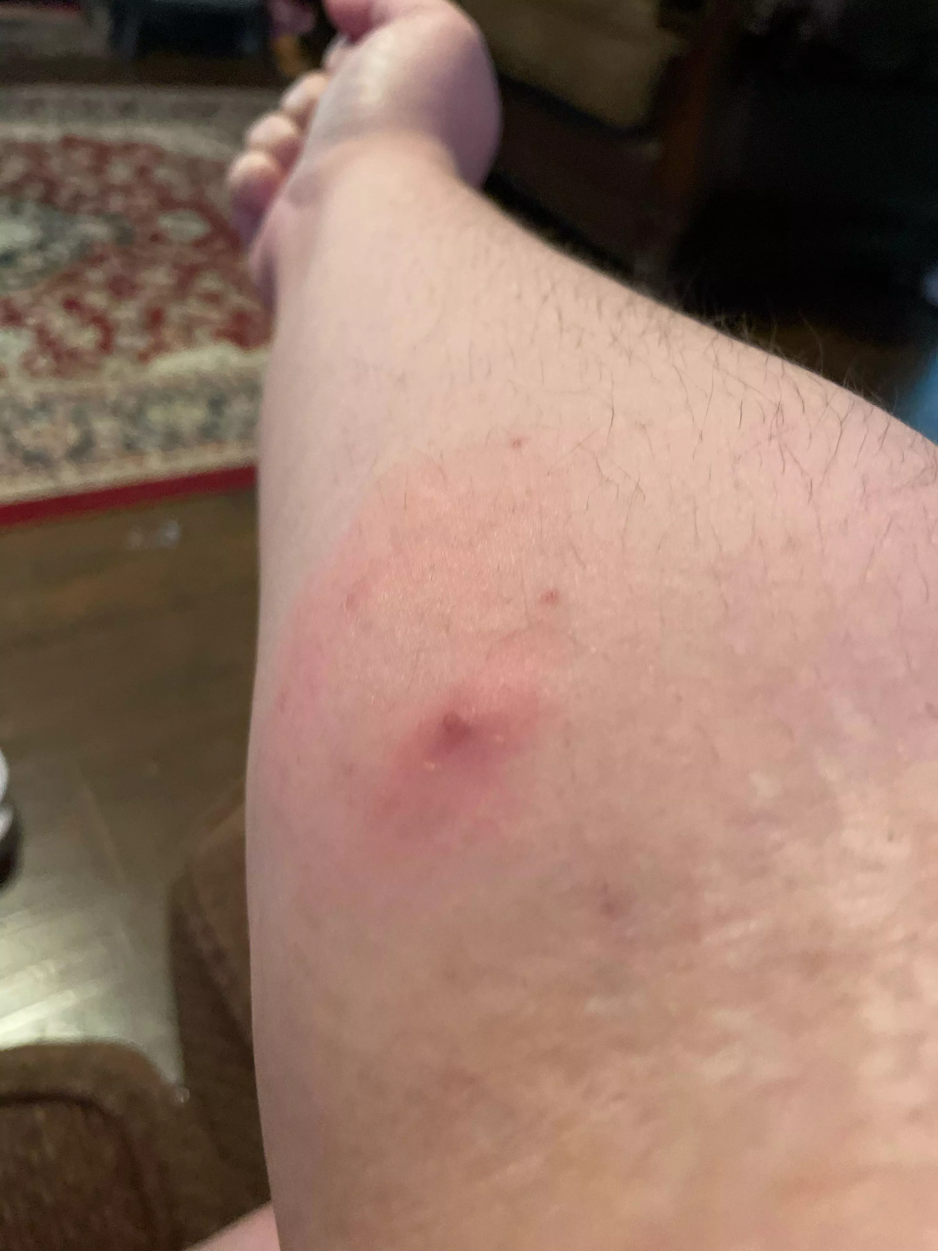 This forbidden pop showed up yesterday and it hurts when I curl my arm posted by Katybee18