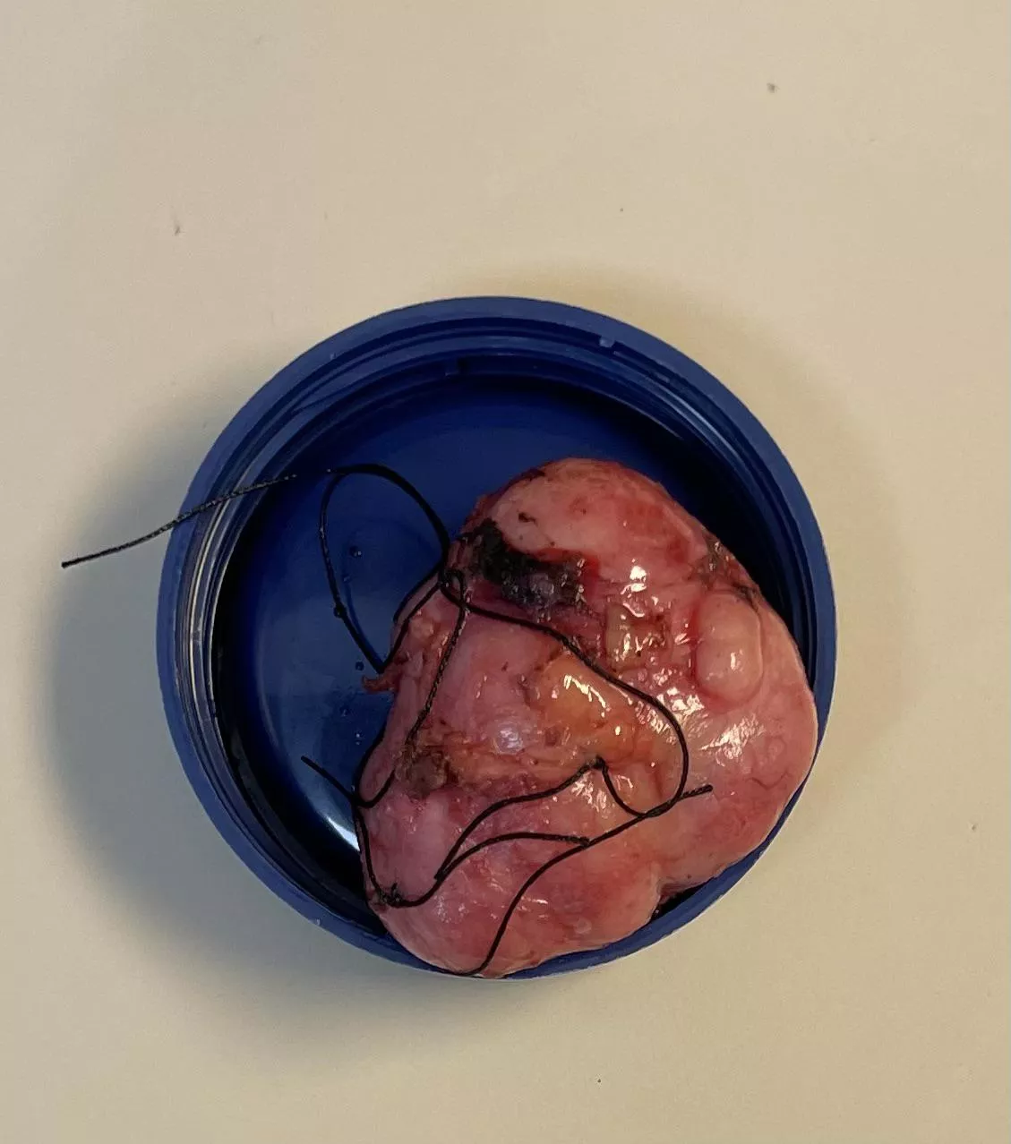 This is Frank, a 20 gram 4.4 x 3.5 x 2.5 (doctor’s official measurement) fibro adenoma removed from my left breast, hence why video was not allowed. He was a beast, but Frank has been yanked! posted by FjotraTheGodless