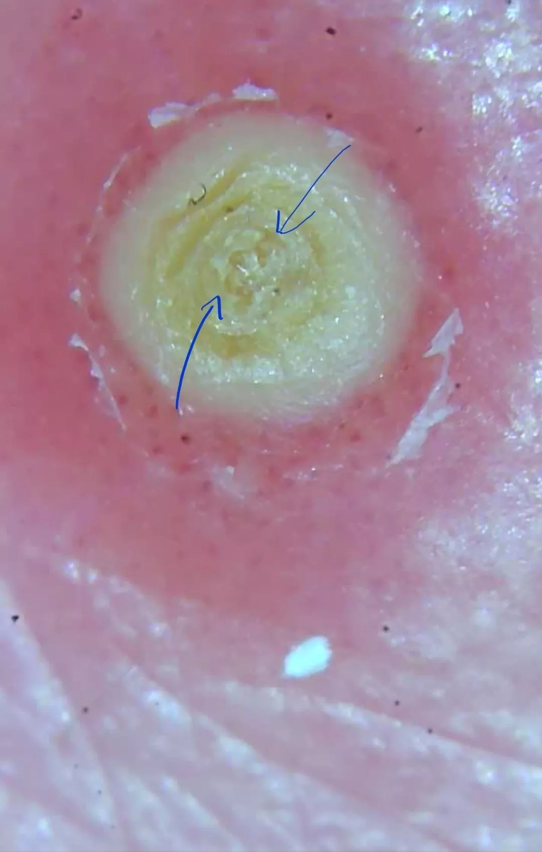 This is on my friends back, she's going to let me pop and video it (I'm doubtful it'll be anything exciting) I had a quick question thought... Does it look like seeds in the middle or am I losing my mind? posted by Irathient