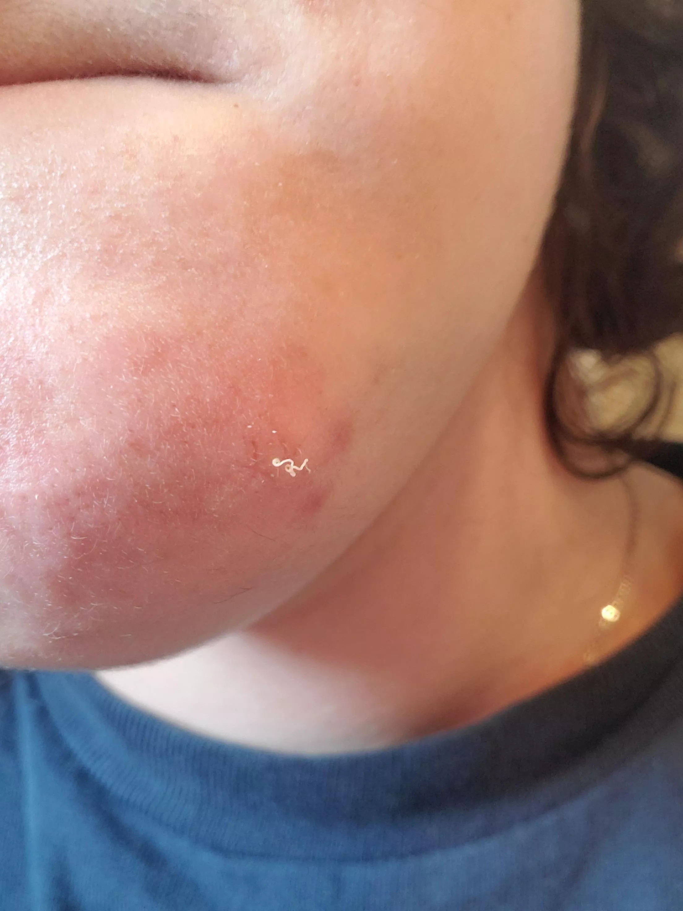 This little squiggly guy on my chin posted by unicatwoman