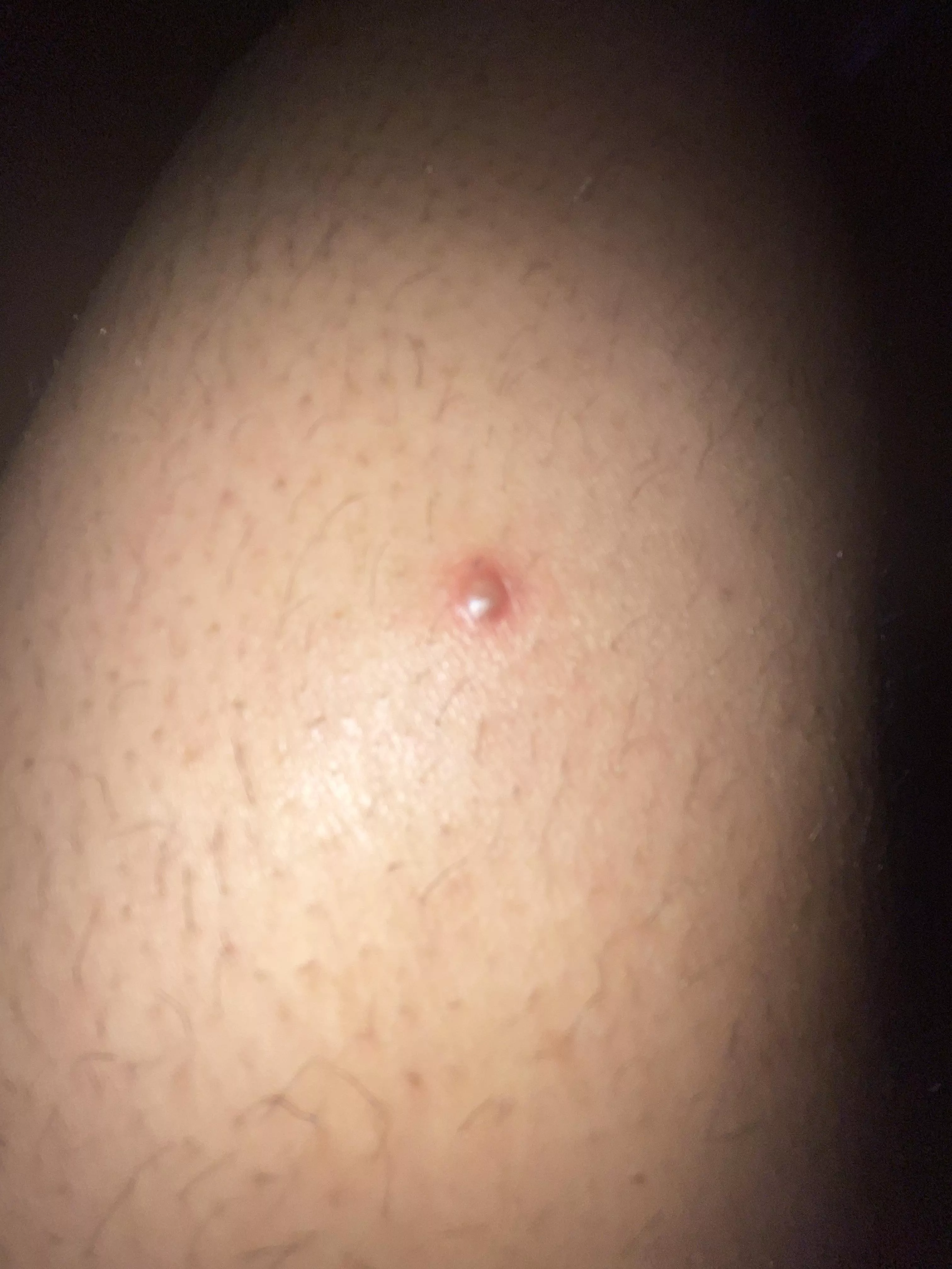 This randomly appeared on my thigh..anyone know what it is?? It hurts to touch posted by i_am_soap-