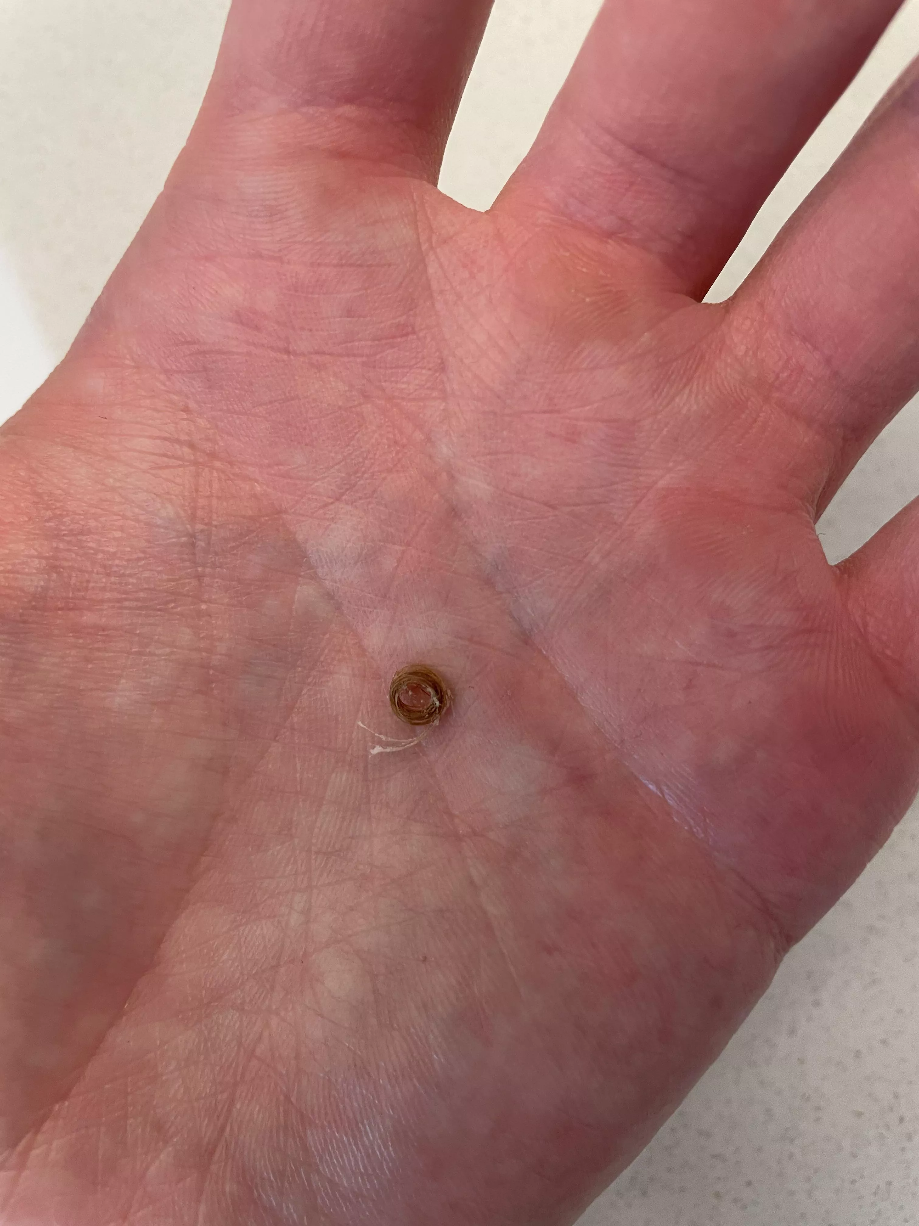 Thought I was just popping a regular blackhead posted by cryle042