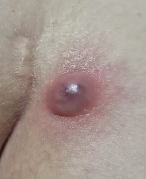 Thought this sub would appreciate my pilonidal cyst by Omnonom