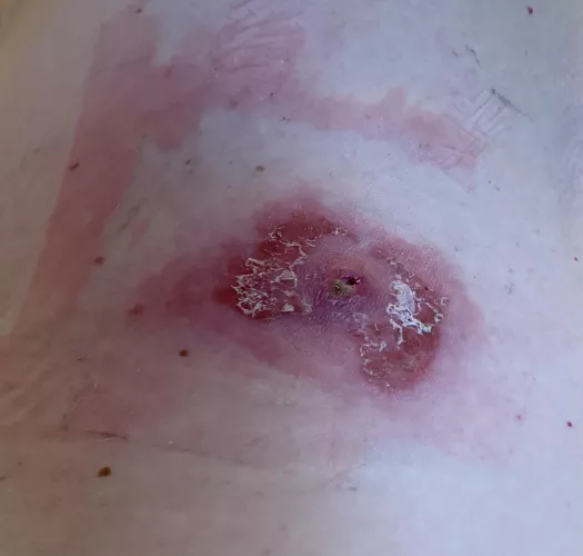 TL;DR - a formerly benign cyst went haywire when my immune system ramped up to fight covid. Had it lanced, then I was allergic to the antibacterial infused bandaids I bought to cover it. I'm in hell. by jadiseoc