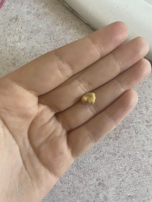 Tonsil stone removed by Cominella