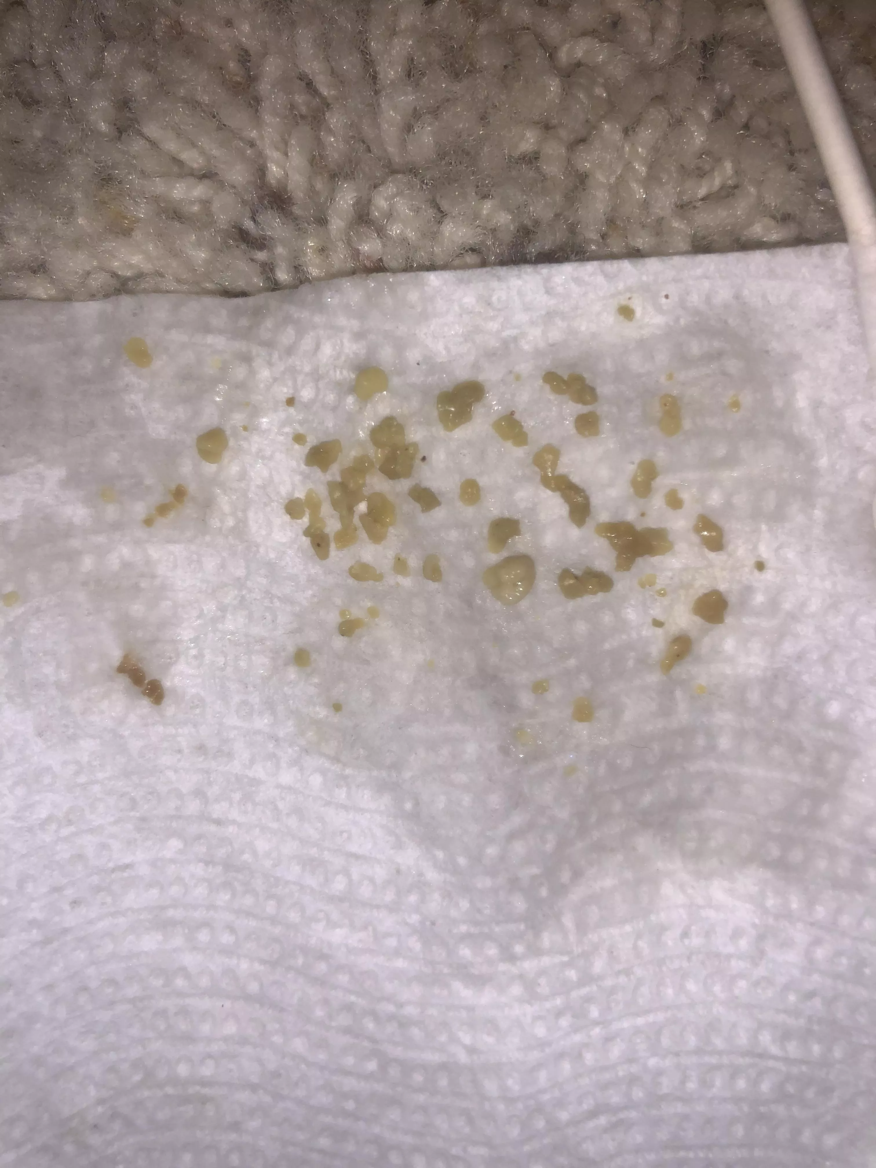 Tonsil stones — these all just came out of one of my tonsils just now, this isn’t even all of them, and they are still coming out. This is so much, is this normal? I’m grossed out posted by rpr33