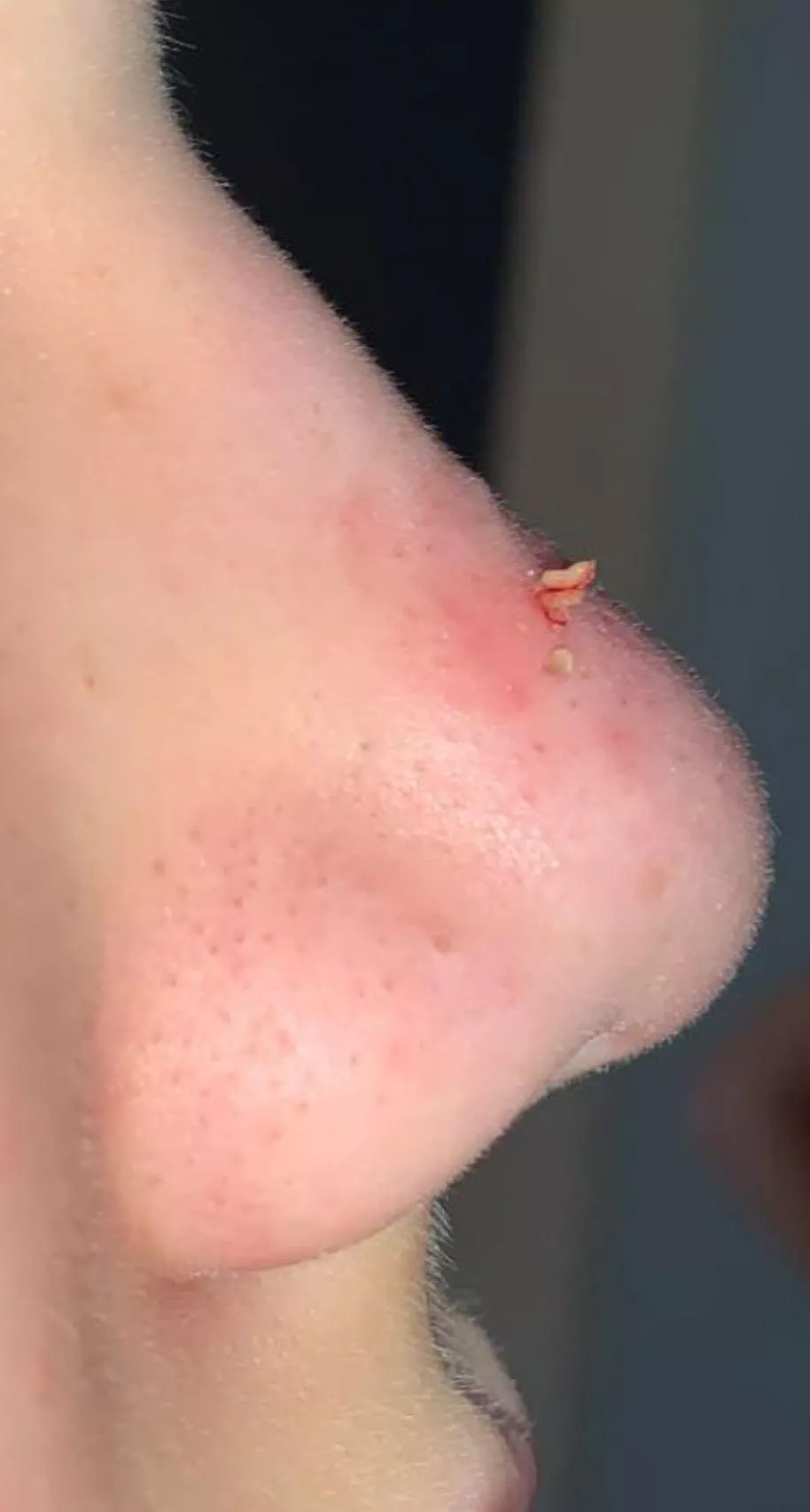 Tried to get a monster off of my 11 year olds nose, got 2.5. posted by purple_lassy