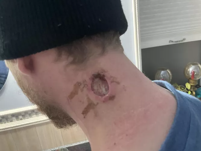 UPDATE: Brother went back to surgeon. We are cleaning / packing it a couple times a day will update more. by ZazzooGaming