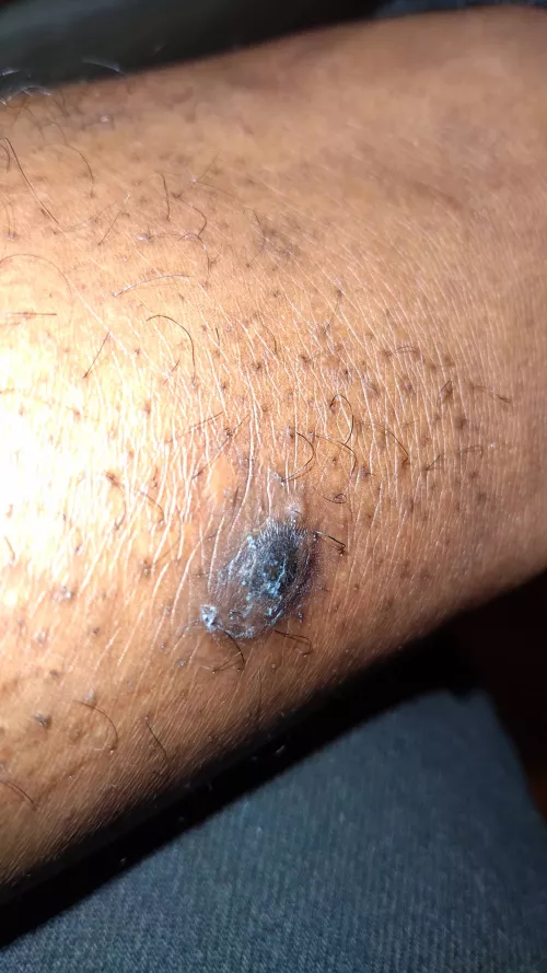 Update: Doctor said it looks like a blister referenced me to a walk in dermatologist by caseyscolumbusss