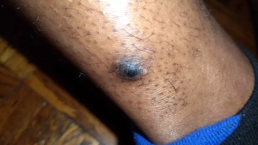 Update: Here what the bump looks like currently by caseyscolumbusss